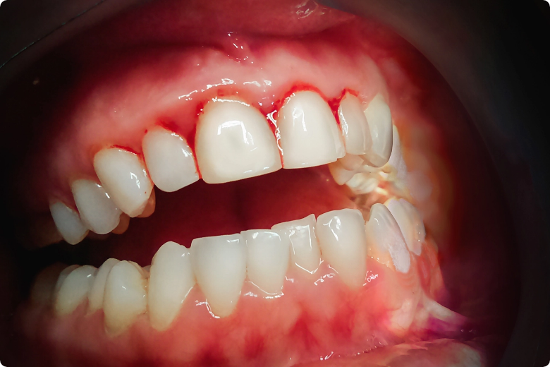Dental cleaning in Colorado Springs, CO - deep teeth cleaning and general & preventive dentistry services